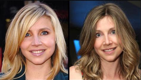 sarah chalke plastic surgery